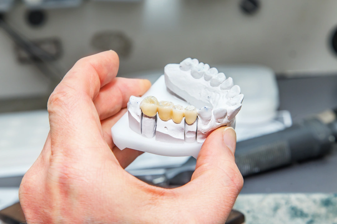 a dental bridge in a plaster mold of the mouth. how a dentist plans for a bridge