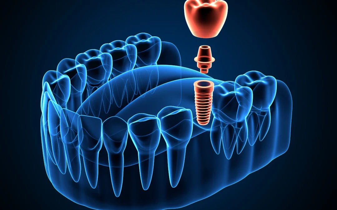 How Long Do Dental Implants Last?
