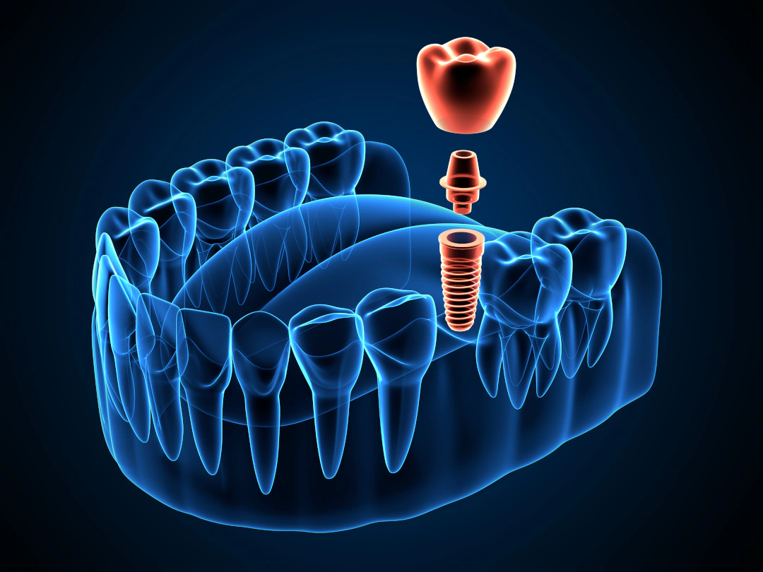 graphic of a dental implant with a crown going into the mouth