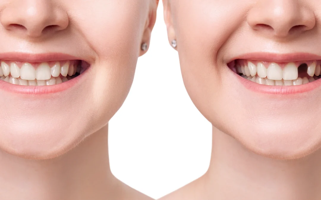 Dental Implants vs. Bridges vs. Dentures: Which Tooth Replacement Option Is Best?