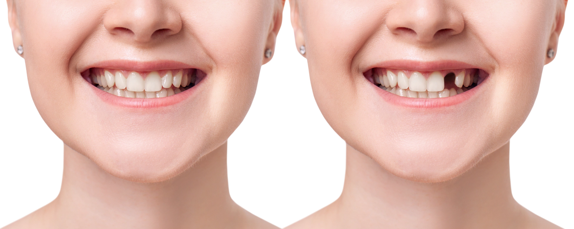 Photo of a before and after tooth replacement